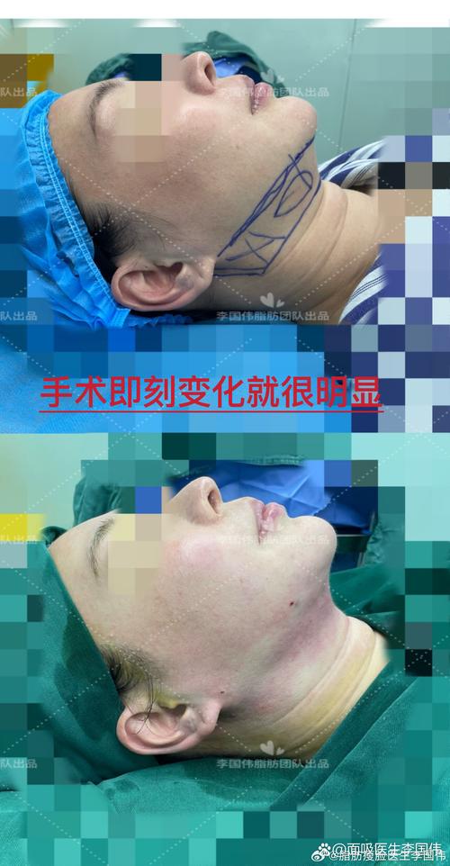 东莞吸脂修复TOP5推荐：揭秘价格、恢复期及正规机构选择