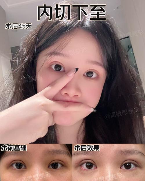 2026安阳下眼睑下至正规医院推荐与价格指南，安全变美避坑必