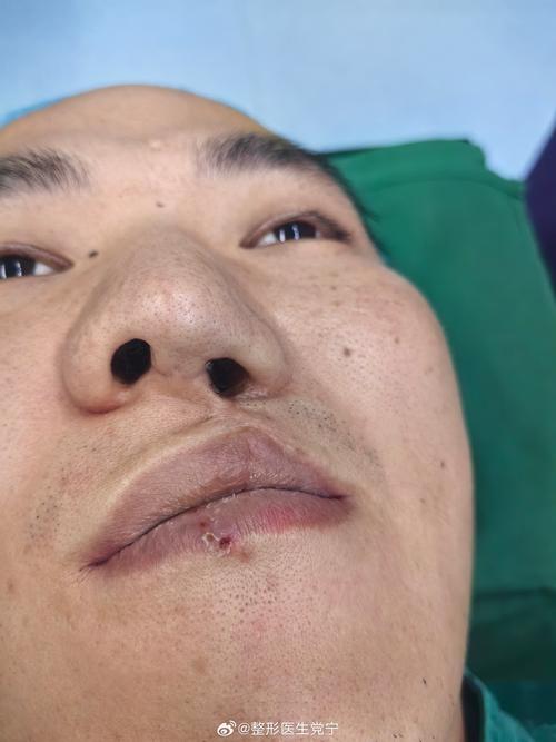 曲靖鼻畸形矫正正规医院推荐:2026年医生资质与价格参考