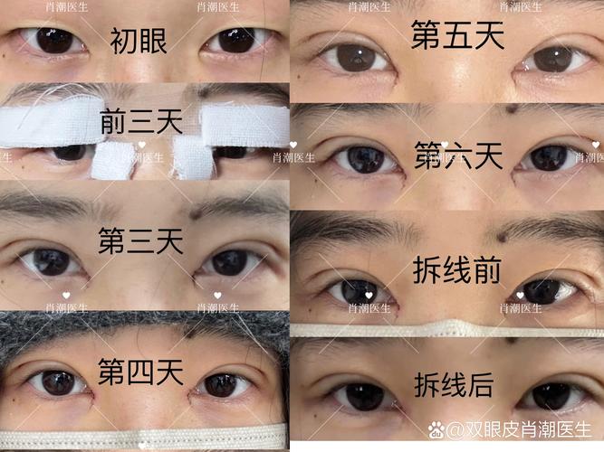 潮州开内眼角正规指南：2026年度价格与口碑深度盘点