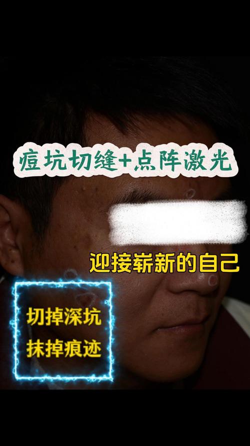 铜仁激光祛痘印十强榜单2026:正规机构推荐、费用解析与避坑