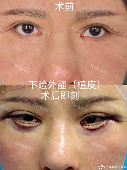 2026年齐齐哈尔眼睑内翻矫正口碑推荐:如何避开“坑”?正规