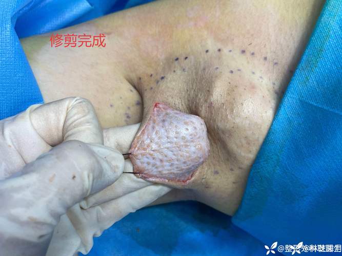 中卫腋臭手术避坑：2026年正规医院推荐与价格参考