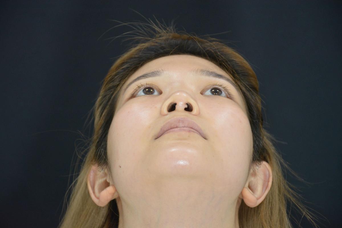忻州肋软骨隆鼻正规医院推荐及价格费用分析(2026更新)