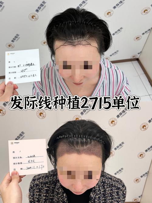 2026台州发际线种植口碑:正规机构推荐与避坑指南