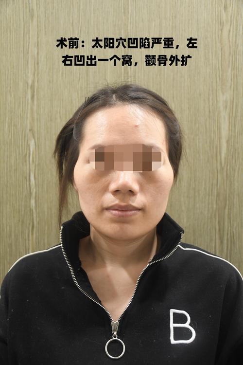 白山颧弓整形怎么样？2026年5大正规医院推荐及避坑指南