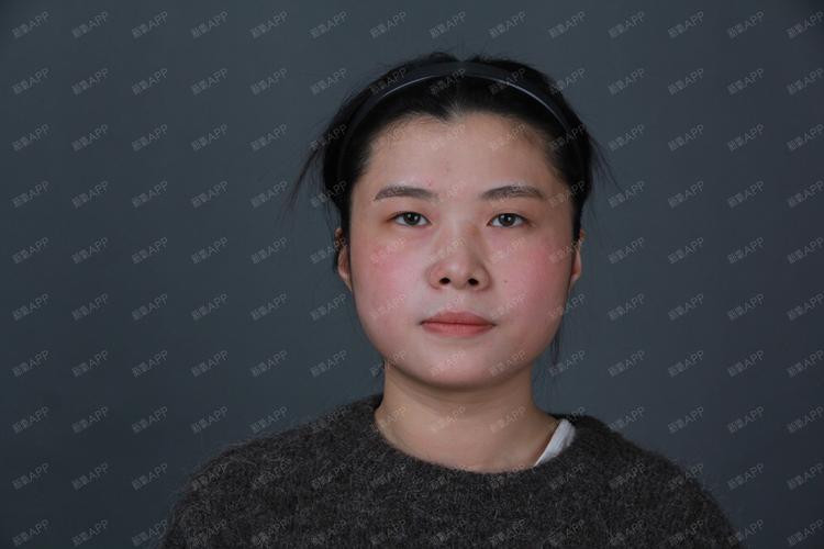 滁州颧骨整形前五：2026年价格、口碑与正规机构推荐清单