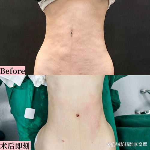 2026中卫腰腹吸脂排名TOP5:脂肪存活率与恢复期全解析