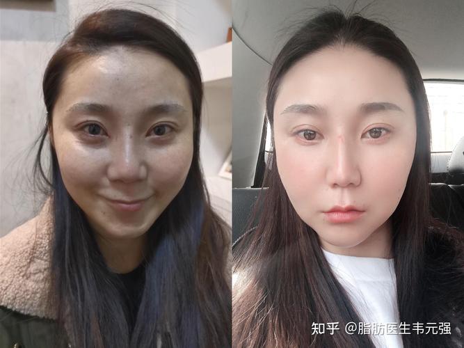 随州自体脂肪丰苹果肌排行:2026口碑推荐清单与费用解析