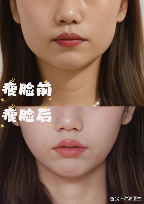 佳木斯颊脂垫去除推荐:正规医院排名与避坑指南