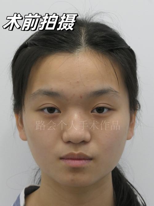 2026平顶山颧弓整形正规医院推荐与价格避坑指南