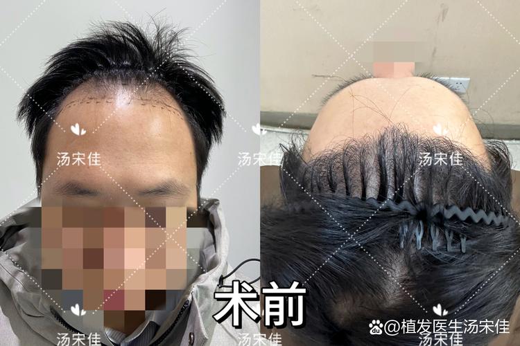 白山发际线种植推荐：2026年正规机构测评与价格参考