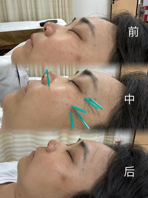 2026衢州除皱针专业推荐TOP3：价格、恢复期与医院资质全