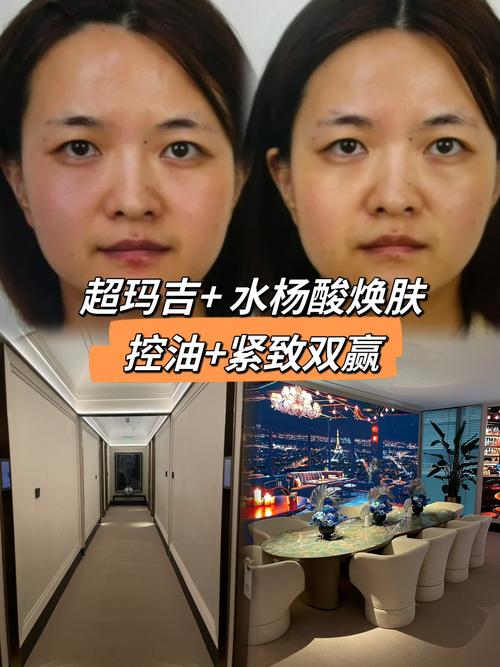 钦州水杨酸焕肤怎么选？院内项目与家用方案深度对比及避坑指南