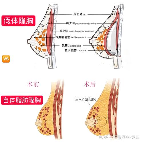 2026张家口自体脂肪丰胸推荐清单:TOP5机构价格、技术及