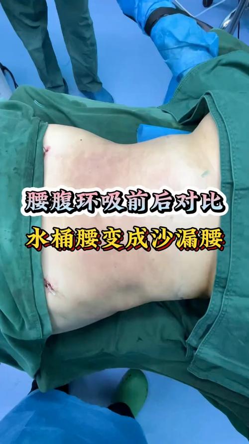 2026年丽水腰腹吸脂前5名盘点：价格、恢复期与避坑指南