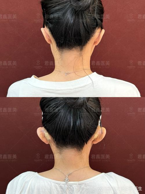 深圳精灵耳整形哪家好？2026正规医院TOP3推荐清单，价格