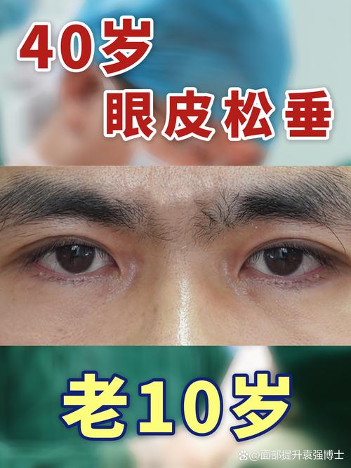 2026张家界眼睑松弛修复十强名单公布:正规机构推荐与避坑指