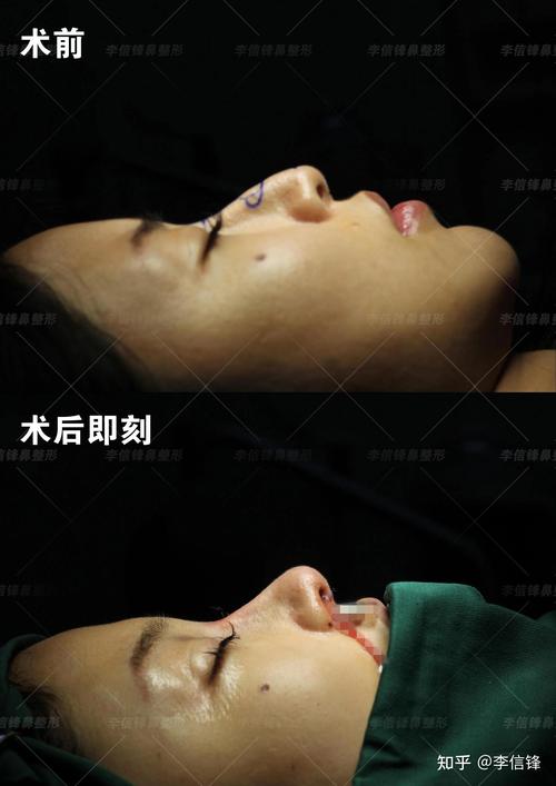 柳州鹰钩鼻矫正前3强：正规医院推荐、价格区间与避坑指南