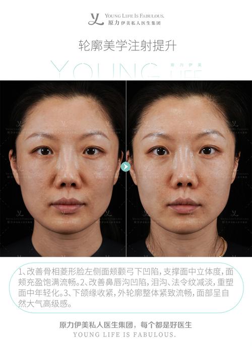 岳阳下颌缘提升注射排行及口碑指南:2026正规机构如何选择?