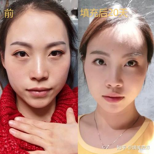 2026鹤壁自体脂肪丰面颊口碑推荐：价格参考与专业避坑指南