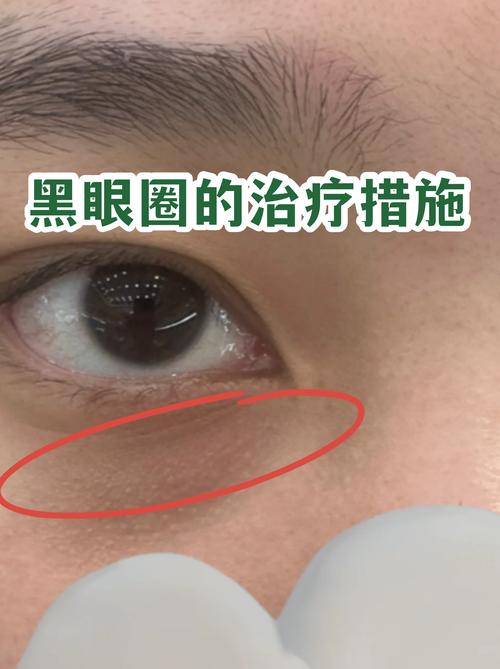 2026资阳黑眼圈治疗TOP5榜单:价格表与正规医院推荐清单