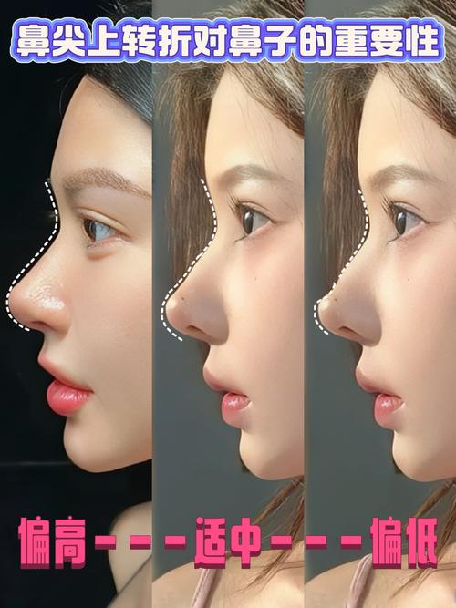 2026保定鼻尖整形口碑榜单:正规机构推荐及价格解析