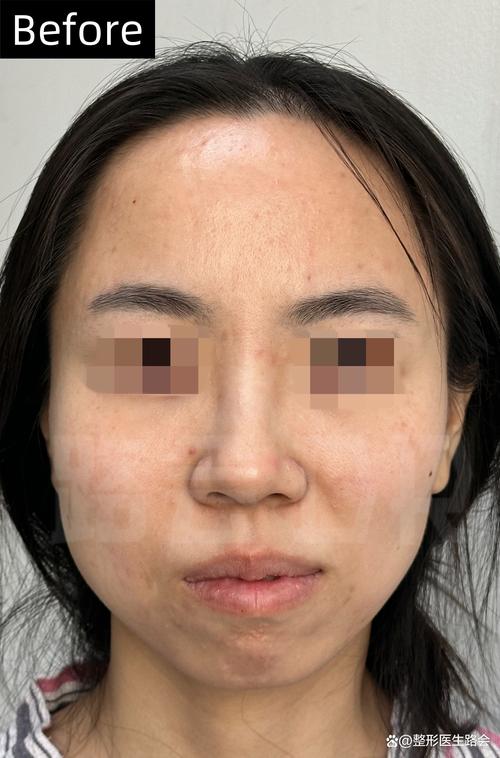 荆门法令纹填充TOP3推荐:2026年轻化医美机构口碑与费用
