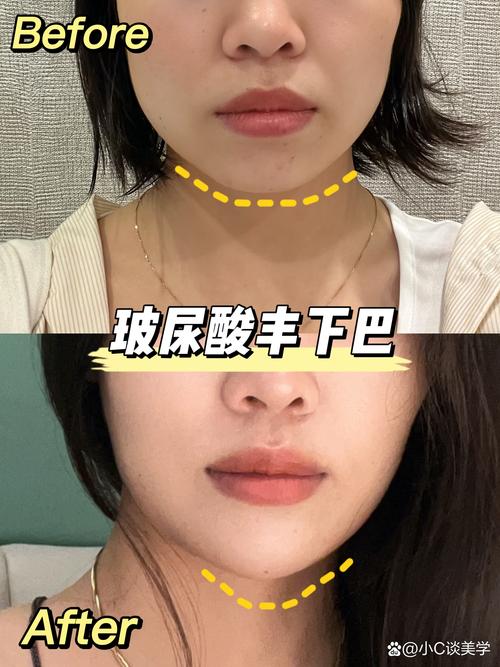 益阳玻尿酸丰下巴费用多少钱?2026正规医院推荐与价格行情盘