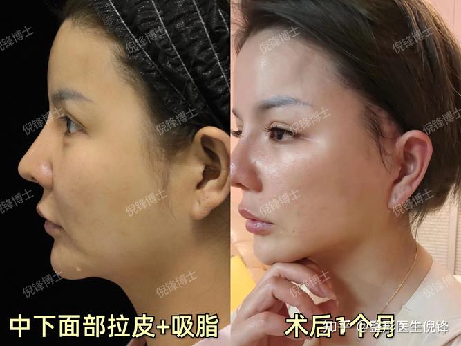 驻马店自体脂肪丰苹果肌哪家好?2026驻马店专业整形机构推荐