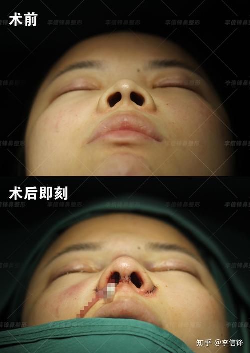 河源鼻孔缩小价格多少？2026河源专业鼻孔缩小手术医院排名与