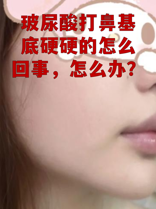 2026曲靖玻尿酸填充鼻基底前五强推荐榜单与价格分析