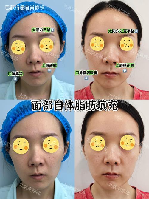 2026吉安自体脂肪丰额头避坑指南：正规机构选择与费用参考