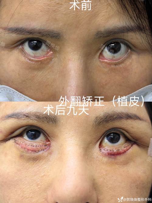 2026池州眼睑内翻矫正医院推荐 哪家做的好 TOP5