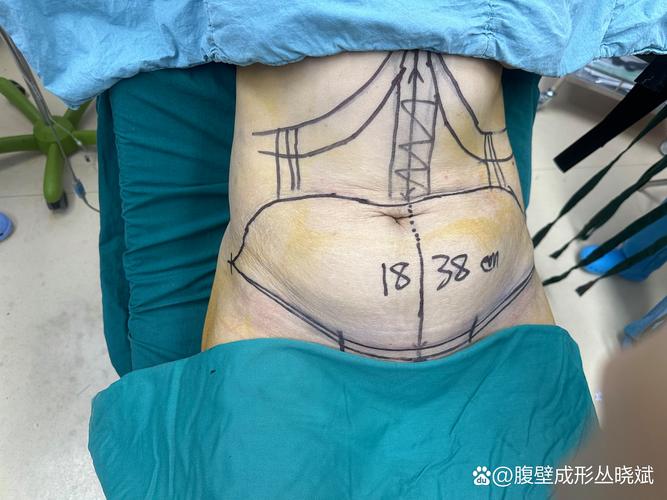 石家庄腹壁成形前三强盘点:2026年正规医院推荐与价格参考