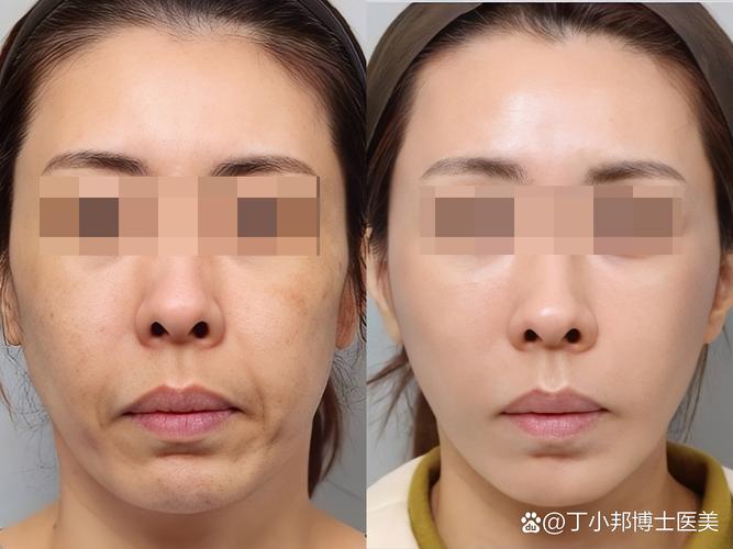 2026宿州木偶纹填充前3强推荐:正规机构与口碑榜单盘点