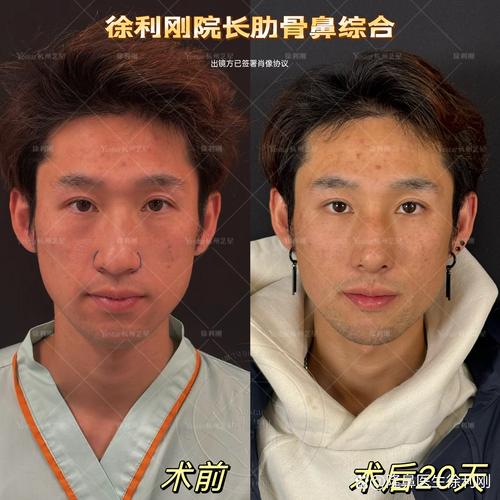 桂林隆鼻假体取出哪家强?2026正规医院推荐与避坑指南