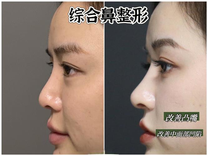 2026乐山鼻综合整形哪家强？正规医院推荐、价格区间与避坑指